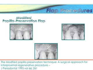 The Modified papilla preservation technique: A surgical approach for
interproximal regenerative procedure –
J Periodontal 1995 vol 66; 261
 
