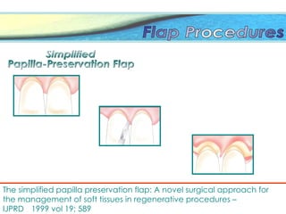 The simplified papilla preservation flap: A novel surgical approach for
the management of soft tissues in regenerative procedures –
IJPRD 1999 vol 19; 589
 