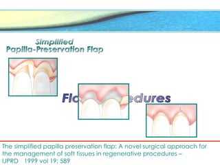 The simplified papilla preservation flap: A novel surgical approach for
the management of soft tissues in regenerative procedures –
IJPRD 1999 vol 19; 589
 