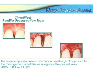 The simplified papilla preservation flap: A novel surgical approach for
the management of soft tissues in regenerative procedures –
IJPRD 1999 vol 19; 589
 