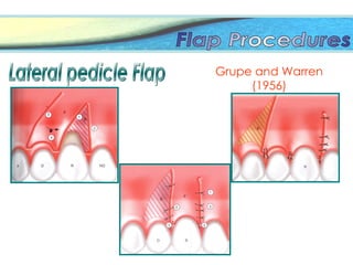 Grupe and Warren
(1956)
 