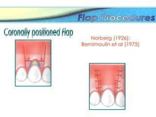Norberg (1926);
Bernimoulin et al (1975)
 