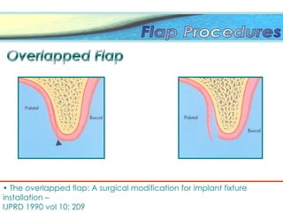 • The overlapped flap: A surgical modification for implant fixture
installation –
IJPRD 1990 vol 10; 209
 
