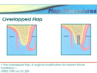 • The overlapped flap: A surgical modification for implant fixture
installation –
IJPRD 1990 vol 10; 209
 