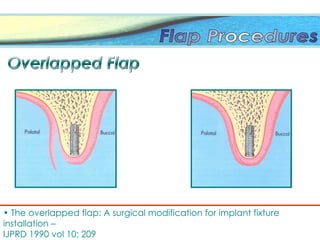 • The overlapped flap: A surgical modification for implant fixture
installation –
IJPRD 1990 vol 10; 209
 