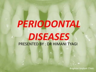 PERIODONTAL
DISEASESPRESENTED BY : DR HIMANI TYAGI
 