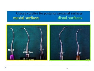 Gracey curettes for posterior proximal surfaces
mesial surfaces distal surfaces
50
 