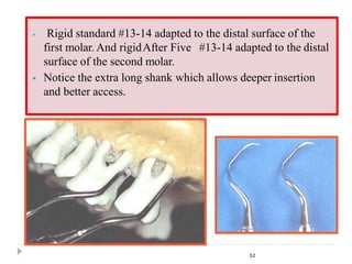  Rigid standard #13-14 adapted to the distal surface of the
first molar. And rigidAfter Five #13-14 adapted to the distal
surface of the second molar.
 Notice the extra long shank which allows deeper insertion
and better access.
52
 