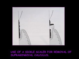 USE OF A SICKLE SCALER FOR REMOVAL OF SUPRAGINGIVAL CALCULUS. 