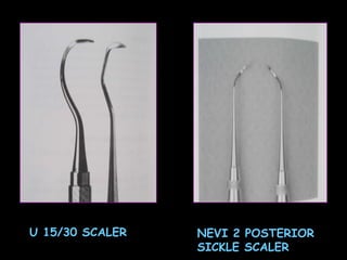U 15/30 SCALER NEVI 2 POSTERIOR SICKLE SCALER 
