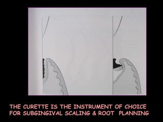 THE CURETTE IS THE INSTRUMENT OF CHOICE FOR SUBGINGIVAL SCALING & ROOT  PLANNING 