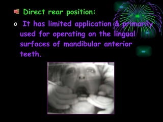 Direct rear position: It has limited application & primarily used for operating on the lingual surfaces of mandibular anterior teeth. 