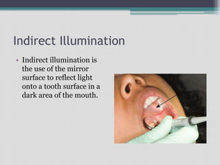 Indirect Illumination
• Indirect illumination is
the use of the mirror
surface to reflect light
onto a tooth surface in a
dark area of the mouth.
 