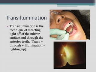 Transillumination
• Transillumination is the
technique of directing
light off of the mirror
surface and through the
anterior teeth. [Trans =
through + Illumination =
lighting up].
 