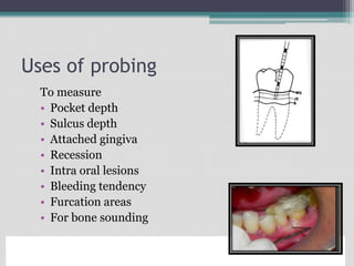 Uses of probing
To measure
• Pocket depth
• Sulcus depth
• Attached gingiva
• Recession
• Intra oral lesions
• Bleeding tendency
• Furcation areas
• For bone sounding
Esther M Wilkins. Examination procedures. In: Wilkins EM. Clinical Practice of the
Dental Hygienist. 9th ed. Philadelphia, PA: Lippincott Williams and Wilkins;
2005:222-245.
 