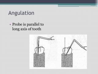 Angulation
• Probe is parallel to
long axis of tooth
 