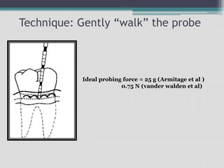 Technique: Gently “walk” the probe
Ideal probing force = 25 g (Armitage et al )
0.75 N (vander walden et al)
 
