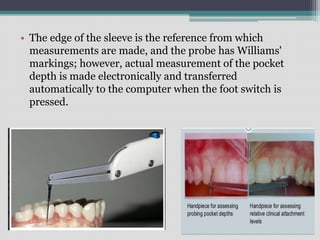 • The edge of the sleeve is the reference from which
measurements are made, and the probe has Williams'
markings; however, actual measurement of the pocket
depth is made electronically and transferred
automatically to the computer when the foot switch is
pressed.
 