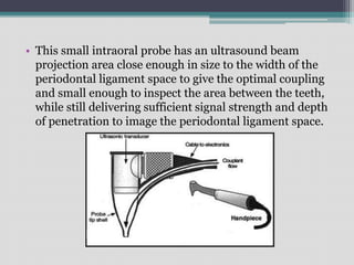 • This small intraoral probe has an ultrasound beam
projection area close enough in size to the width of the
periodontal ligament space to give the optimal coupling
and small enough to inspect the area between the teeth,
while still delivering sufficient signal strength and depth
of penetration to image the periodontal ligament space.
 