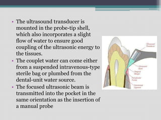 • The ultrasound transducer is
mounted in the probe-tip shell,
which also incorporates a slight
flow of water to ensure good
coupling of the ultrasonic energy to
the tissues.
• The couplet water can come either
from a suspended intravenous-type
sterile bag or plumbed from the
dental-unit water source.
• The focused ultrasonic beam is
transmitted into the pocket in the
same orientation as the insertion of
a manual probe
 