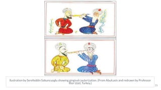 llustration by Serefeddin Sabuncuoglu showing gingival cauterization. (From Abulcasis and redrawn by Professor
Ilter Uzel, Turkey.)
11
 