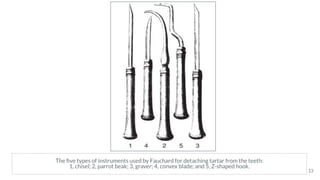 The ﬁve types of instruments used by Fauchard for detaching tartar from the teeth:
1, chisel; 2, parrot beak; 3, graver; 4, convex blade; and 5, Z-shaped hook.
13
 