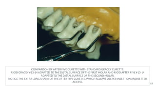 COMPARISON OF AFTER FIVE CURETTE WITH STANDARD GRACEY CURETTE:
RIGID GRACEY #13-14 ADAPTED TO THE DISTAL SURFACE OF THE FIRST MOLAR AND RIGID AFTER FIVE #13-14
ADAPTED TO THE DISTAL SURFACE OF THE SECOND MOLAR.
NOTICE THE EXTRA LONG SHANK OF THE AFTER FIVE CURETTE, WHICH ALLOWS DEEPER INSERTION AND BETTER
ACCESS.
83
 