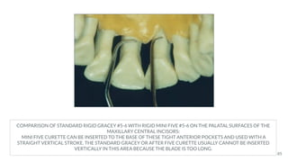 COMPARISON OF STANDARD RIGID GRACEY #5-6 WITH RIGID MINI FIVE #5-6 ON THE PALATAL SURFACES OF THE
MAXILLARY CENTRAL INCISORS:
MINI FIVE CURETTE CAN BE INSERTED TO THE BASE OF THESE TIGHT ANTERIOR POCKETS AND USED WITH A
STRAIGHT VERTICAL STROKE. THE STANDARD GRACEY OR AFTER FIVE CURETTE USUALLY CANNOT BE INSERTED
VERTICALLY IN THIS AREA BECAUSE THE BLADE IS TOO LONG.
85
 