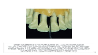 GRACEY CURVETTE SUB-0 ON THE PALATAL SURFACE OF A MAXILLARY CENTRAL INCISOR.
THE LONG SHANK AND SHORT, CURVED, BLUNTED TIP MAKE THIS A SUPERIOR INSTRUMENT FOR DEEP
ANTERIOR POCKETS. THIS CURETTE PROVIDES EXCELLENT BLADE ADAPTATION TO THE NARROW ROOT
CURVATURES OF THE MAXILLARY AND MANDIBULAR ANTERIOR TEETH.
90
 