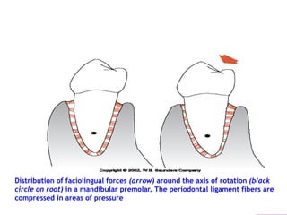 Distribution of faciolingual forces (arrow) around the axis of rotation (black
circle on root) in a mandibular premolar. The periodontal ligament fibers are
compressed in areas of pressure
 