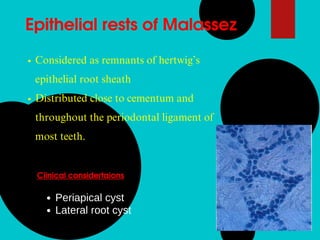 Epithelial rests of Malassez
Considered as remnants of hertwig’s
epithelial root sheath
Distributed close to cementum and
throughout the periodontal ligament of
most teeth.
Clinical considertaions
Periapical cyst
Lateral root cyst
 