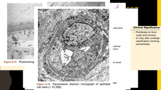 EPITHELIAL RESTS OF MALASSEZ
Represent the remnants
of developmental
Hertwig’s epithelial root
sheath which is involved
in differentiation of root
odontoblasts and also
secrete enamel like
proteins on the root
surface.
Form a latticework in the
periodontal ligament
appear as either isolated
clusters of cells or
interlacing strands.
Arranged in close
packing of cuboidal cells,
completely surrounded
by connective tissue
 