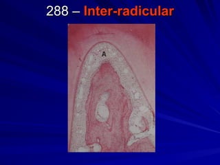 Interradicular Inection Periodontal Ligament & Development presentation | PPT
