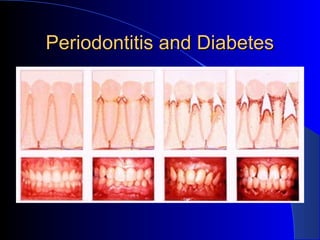 Periodontitis and Diabetes

 