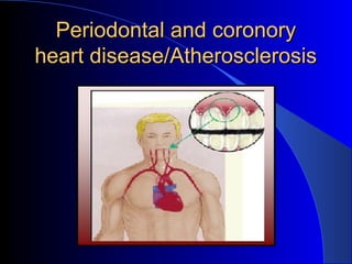 Periodontal and coronory
heart disease/Atherosclerosis

 