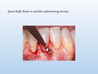 Undermining Incision Comprehensive Overview of Periodontal Microsurgery Techniques and Tools ...