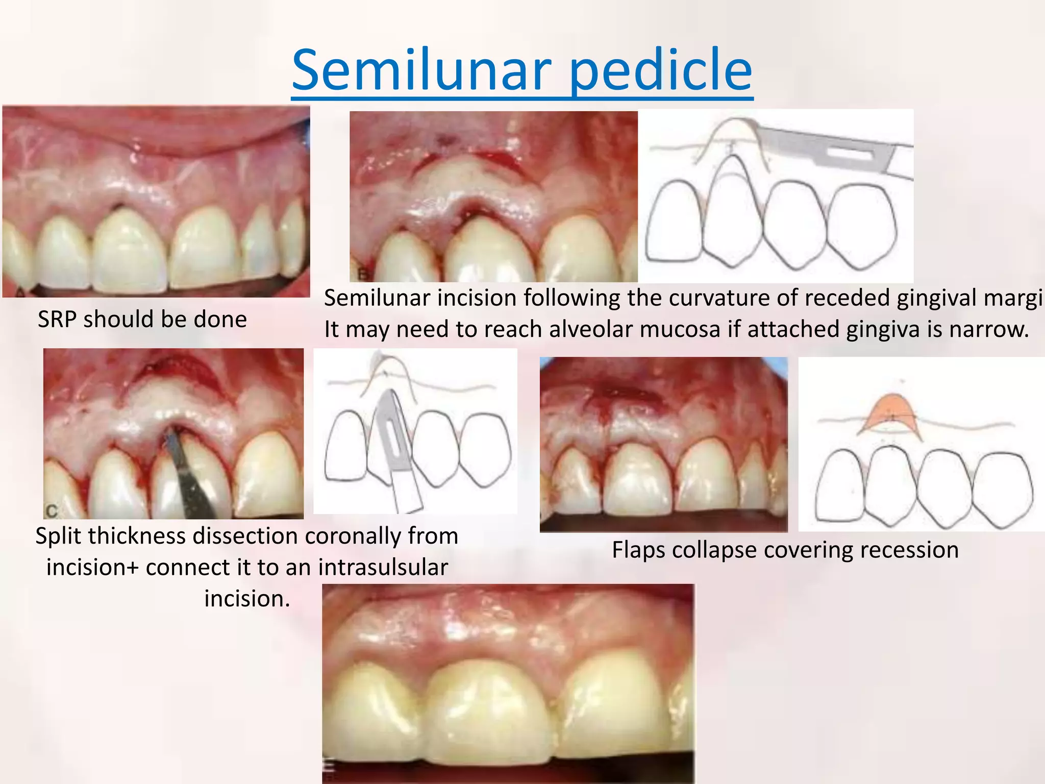 Periodontal plastic and esthetic surgery | PPTX
