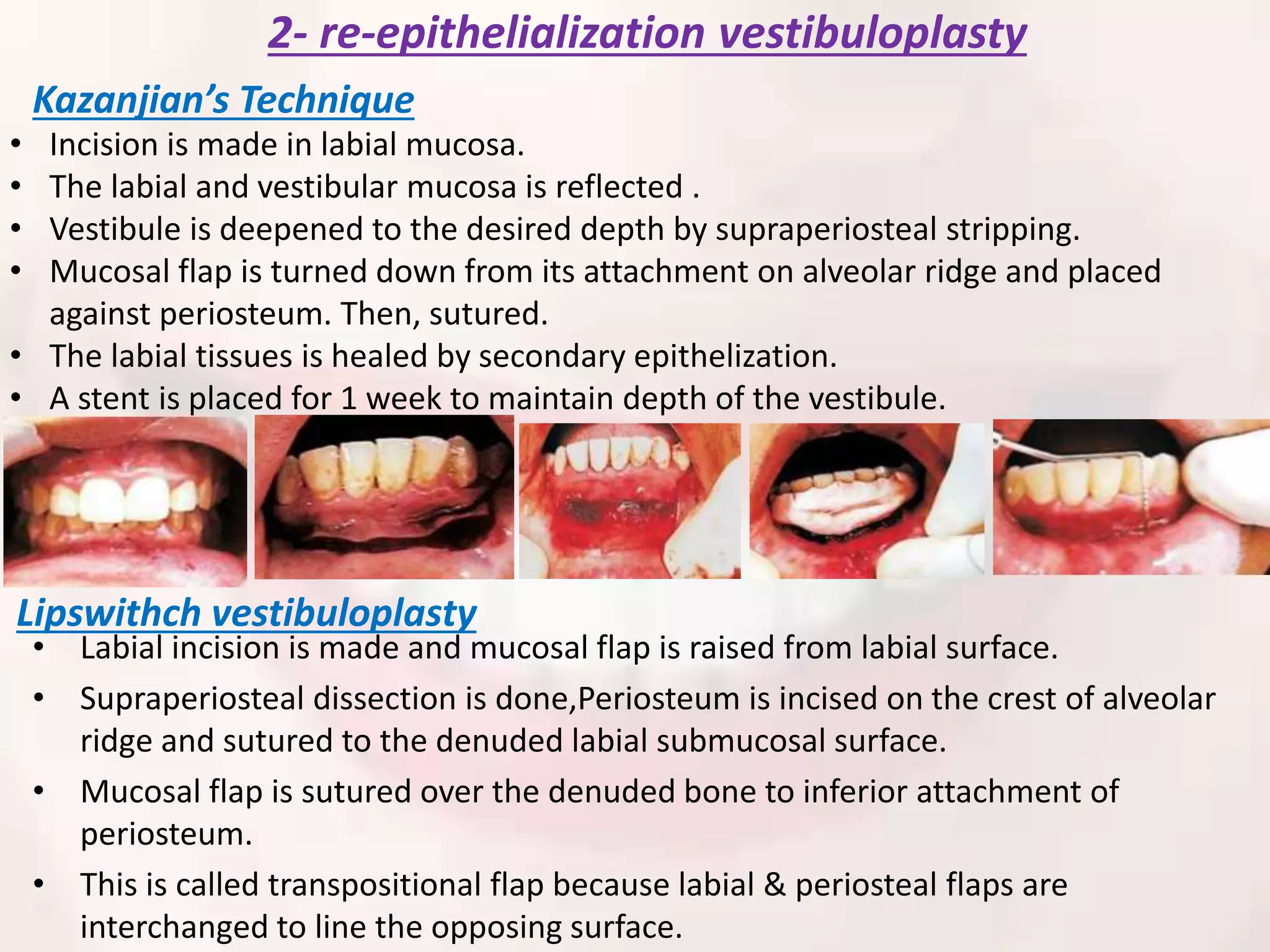 Periodontal plastic and esthetic surgery | PPTX