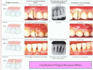 New Miller Classification Periodontal plastic & esthetic surgery | PPTX