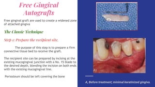 ● Extend the incisions to approximately
twice the desired width of the attached
gingiva, allowing for 50% contraction of
t...