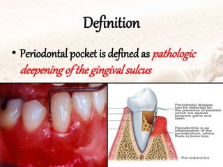 Definition
• Periodontal pocket is defined as pathologic
deepeningof the gingivalsulcus
 