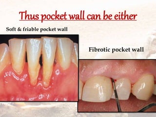 Thus pocket wall can be either
Soft & friable pocket wall
Fibrotic pocket wall
 