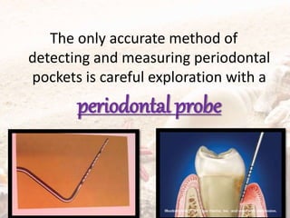 The only accurate method of
detecting and measuring periodontal
pockets is careful exploration with a
periodontal probe
 