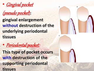 • Gingivalpocket
(pseudopocket):
gingival enlargement
without destruction of the
underlying periodontal
tissues
• Periodontalpocket:
This type of pocket occurs
with destruction of the
supporting periodontal
tissues
 