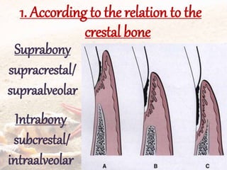 1. According to the relation to the
crestal bone
Suprabony
supracrestal/
supraalveolar
Intrabony
subcrestal/
intraalveolar
 