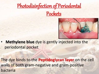 Photodisinfection of Periodontal
Pockets
• Methylene blue dye is gently injected into the
periodontal pocket
The dye binds to the Peptidoglycan layer on the cell
walls of both gram-negative and gram-positive
bacteria
 