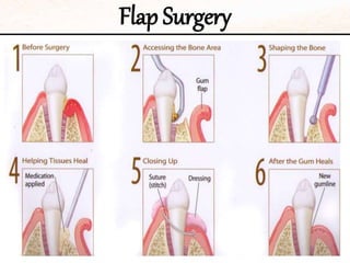 Flap Surgery
 