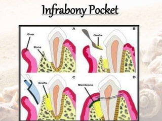 Infrabony Pocket
 