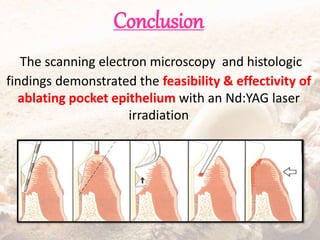 Conclusion
The scanning electron microscopy and histologic
findings demonstrated the feasibility & effectivity of
ablating pocket epithelium with an Nd:YAG laser
irradiation
 
