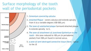 Surface morphology of the tooth
wall of the periodontal pockets
1. Cementum covered by calculus
2. Attached Plaque – covers calculus and extends apically
from it to a variable degree (100-500 µm)
3. The zone of unattached plaque Surround attached plaque
& extends apically to it.
4. The zone of attachment of Junctional Epithelium to the
tooth – this zone reduced to 100 µm (in periodontal
pocket) from 500 µm found in normal sulcus.
5. a zone of semi-destroyed connective tissue fibres – apical
to the JE
 
